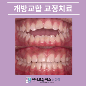 대치동치아교정1